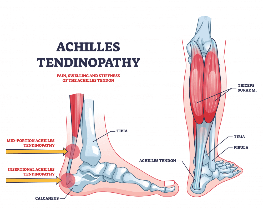 Achilles Tendinitis