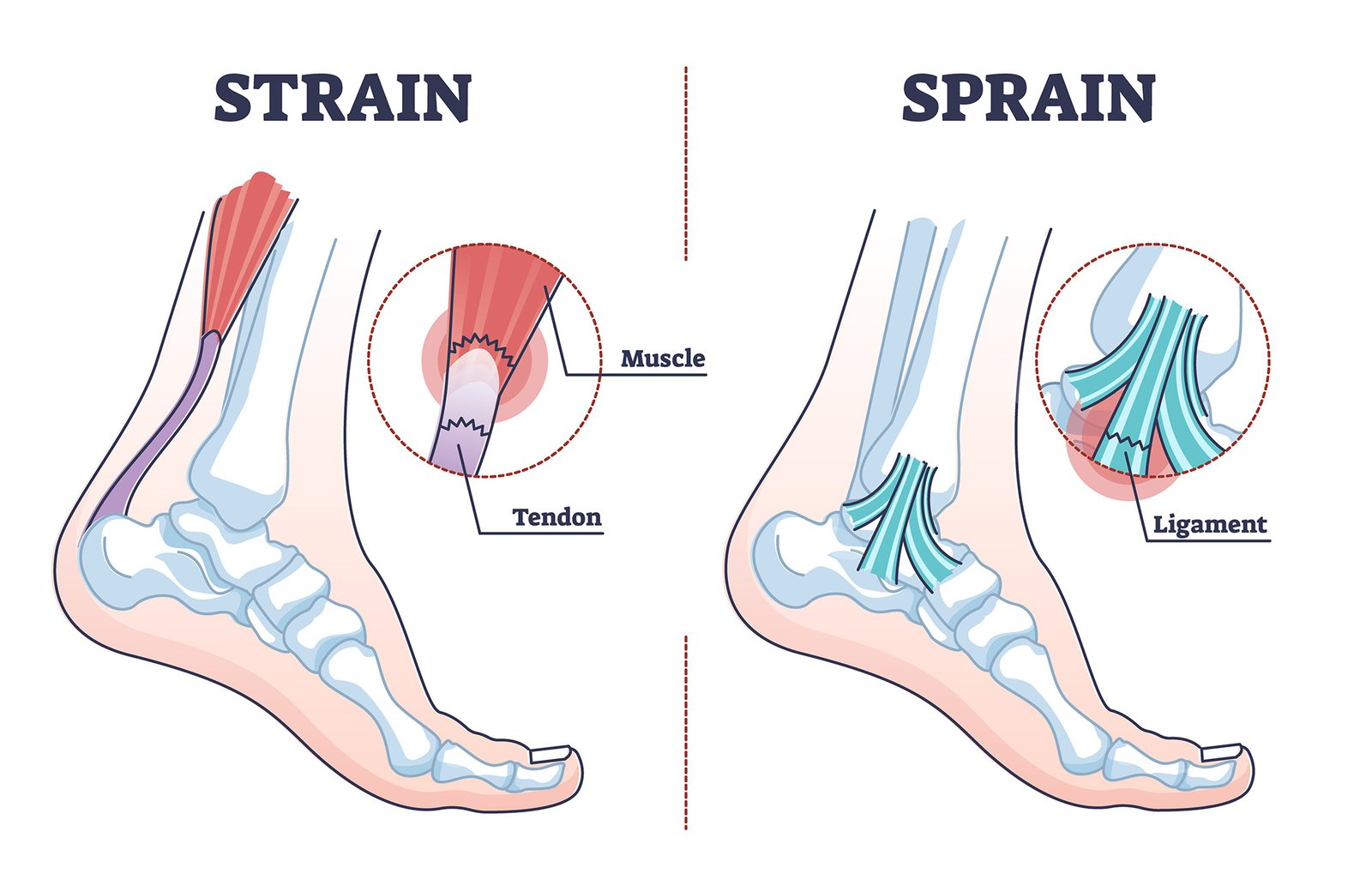 Ankle pain
