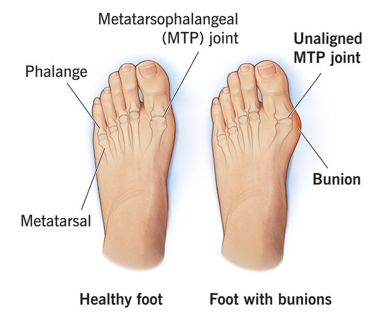 Bunions