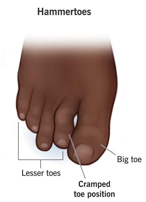 Hammer Toes