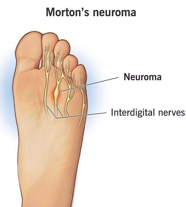 Morton’s neuroma