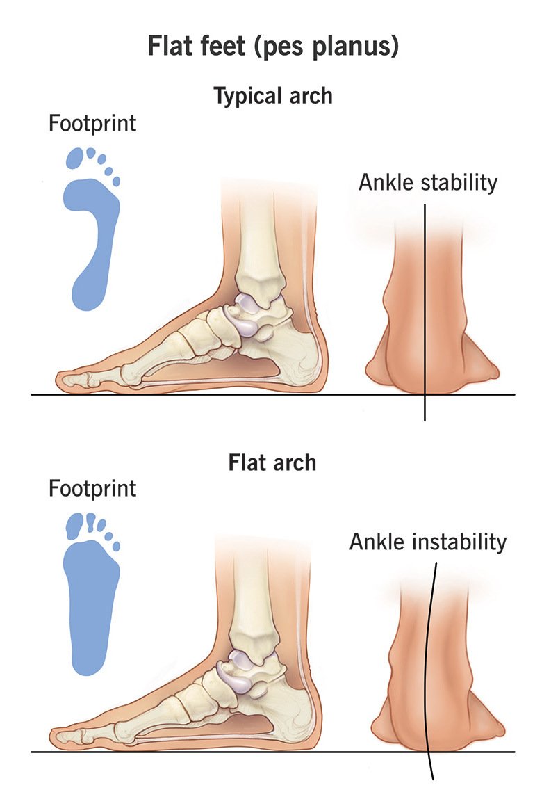Pain from flat feet