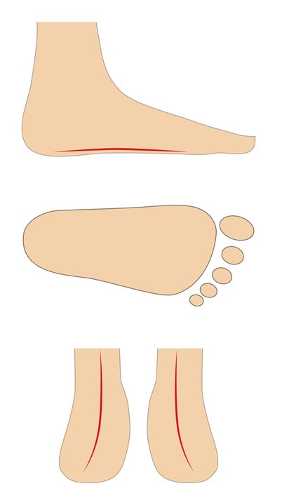 Flat Foot