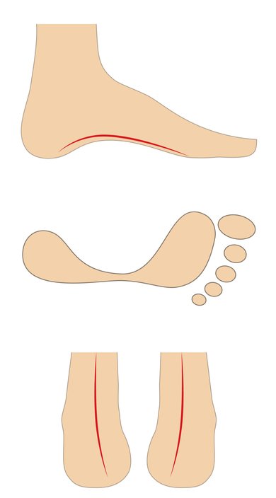 High Arched Foot